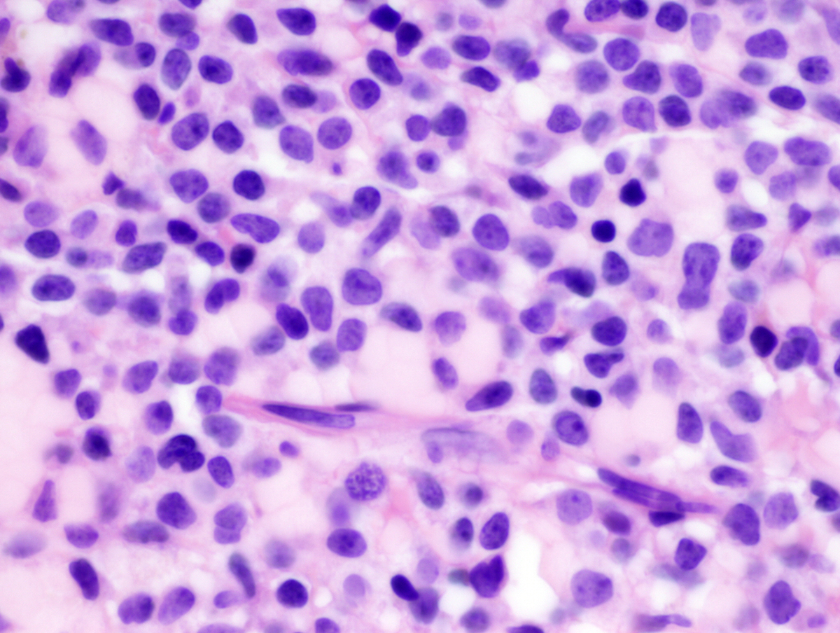 High magnification view of bone marrow biopsy